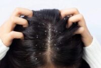 Dandruff treatment