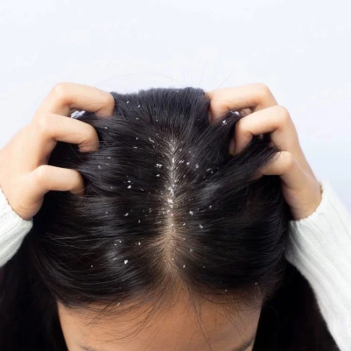 Dandruff treatment